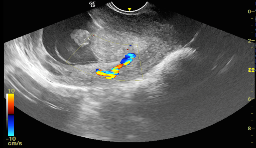 Transvaginal Sonographic Diagnosis of an Endometrial Polyp Causing ...