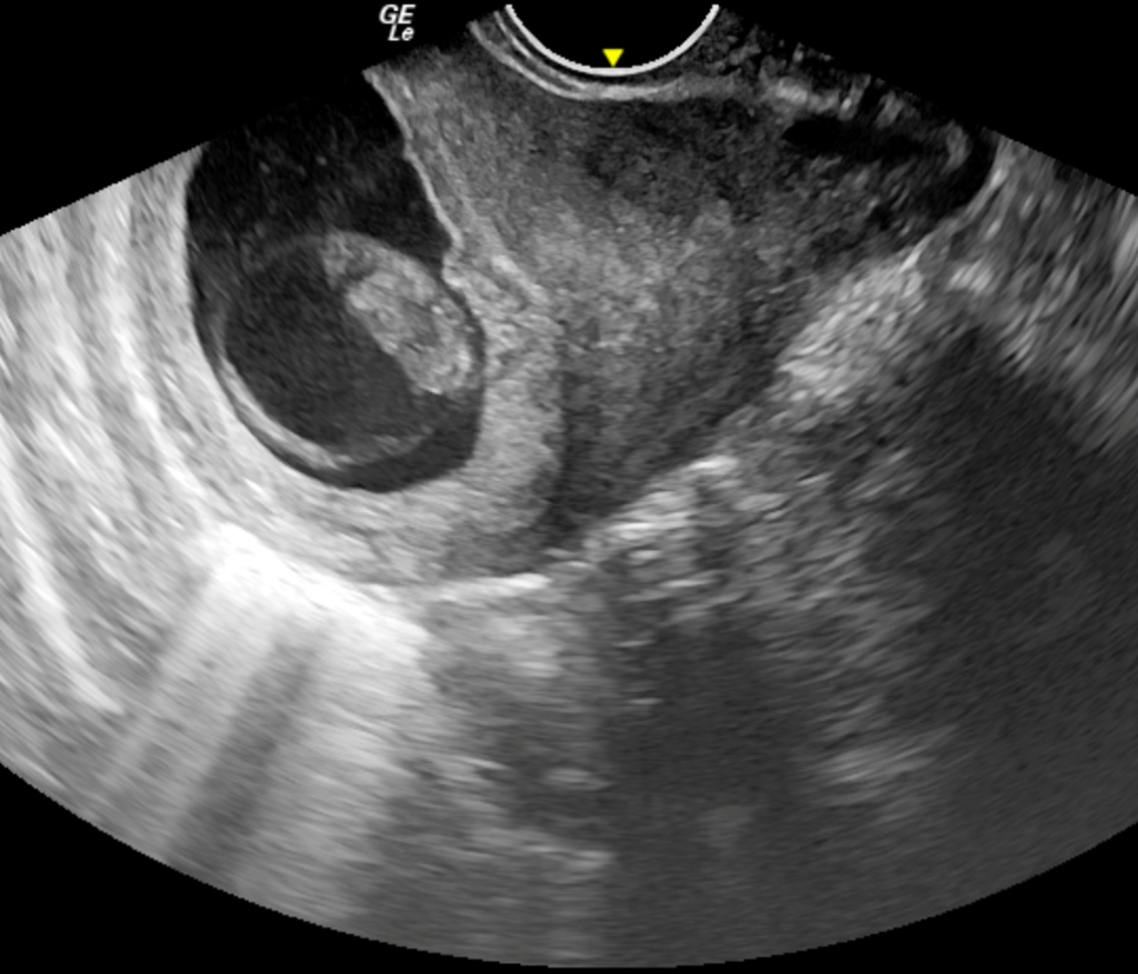 Uterine Cavity Ultrasound